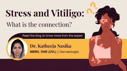 Stress and Vitiligo