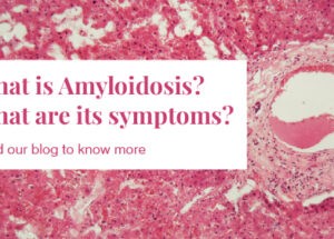 Amyloidosis: Causes and Treatment