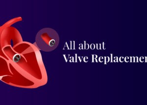 Valve Replacement Surgery: Types, Procedures, and Recovery
