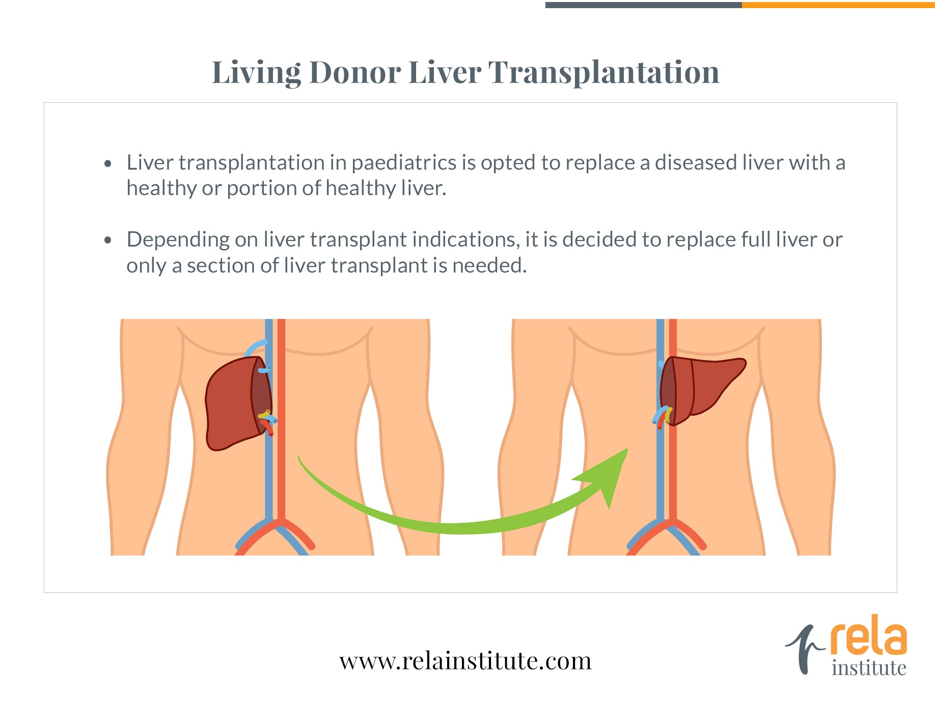 Paediatric Liver Transplantation