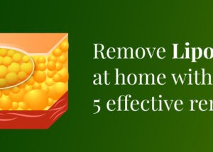 How to remove a lipoma yourself