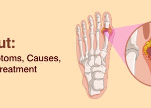 What is gout disease: Symptoms and Treatment